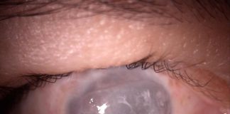 Queratopigmentación: el “tatuaje corneal” que mejora la apariencia del ojo blanco