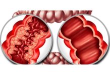 Resultados en minutos: un avance clave para el manejo de la enfermedad inflamatoria intestinal Resultados en minutos: un avance clave para el manejo de la enfermedad inflamatoria intestinal