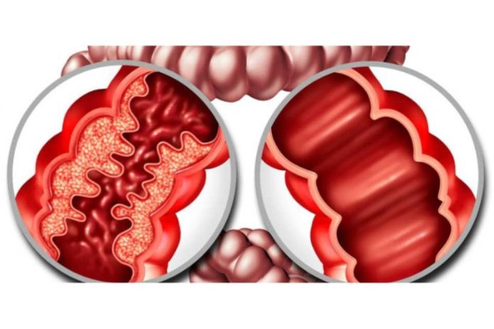 Resultados en minutos: un avance clave para el manejo de la enfermedad inflamatoria intestinal