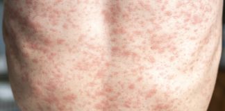 Alarma por Sarampión en Chile: ¿Qué hacer y cómo prevenir contagios?