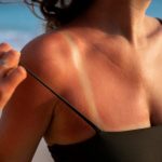 Verano y piel al límite: los problemas estéticos que más aumentan con el sol… y cómo prevenirlos