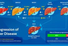 Nuevos tratamientos farmacológicos para el hígado graso metabólico (MASLD/MASH)