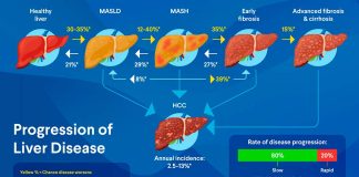 Nuevos tratamientos farmacológicos para el hígado graso metabólico (MASLD/MASH)