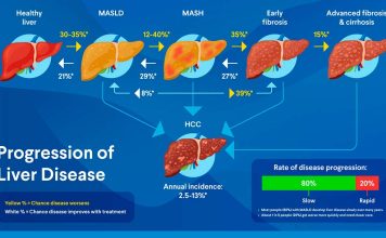 Nuevos tratamientos farmacológicos para el hígado graso metabólico (MASLD/MASH)
