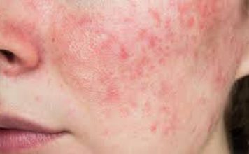 Calor y humedad: por qué aumentan los casos de dermatitis en verano