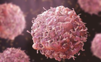 Cáncer en Chile: El desafío de alcanzar el 70% de supervivencia mediante la medicina de precisión y prevención