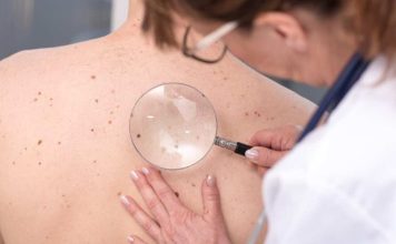 Chequeos gratuitos de lunares en Reñaca: el 90% de los casos de cáncer de piel son curables si se detectan a tiempo