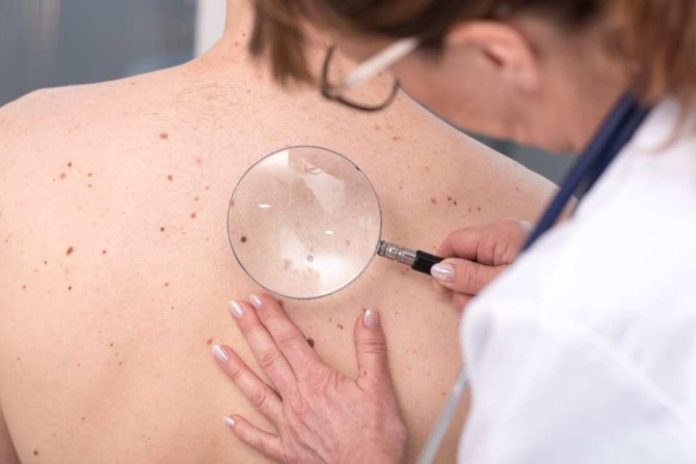 Chequeos gratuitos de lunares en Reñaca: el 90% de los casos de cáncer de piel son curables si se detectan a tiempo