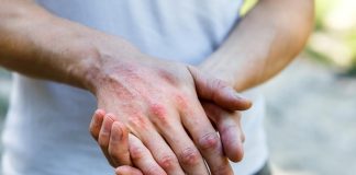 Consejos de un dermatólogo para el verano si sufres de dermatitis atópica