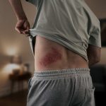 El impacto oculto del herpes zóster: aumenta en un 40% el riesgo de sufrir un accidente cardiovascular El impacto oculto del herpes zóster: aumenta en un 40% el riesgo de sufrir un accidente cardiovascular