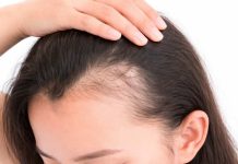 La caída del pelo no es sólo genética: estrés, malos hábitos y alimentación deficiente afectan a mujeres de cualquier edad