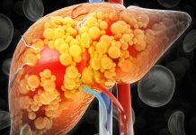 Cáncer Nuevo estudio vincula la variación genética con daños hepáticos causados por la quimioterapia en pacientes con metástasis hepáticas de cáncer colorrectal