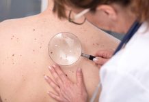 Operativo de chequeo de lunares gratuito llega a Reñaca para detectar y prevenir el cáncer a la piel Operativo de chequeo de lunares gratuito llega a Reñaca para detectar y prevenir el cáncer a la piel