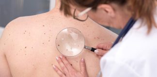 Operativo de chequeo de lunares gratuito llega a Reñaca para detectar y prevenir el cáncer a la piel