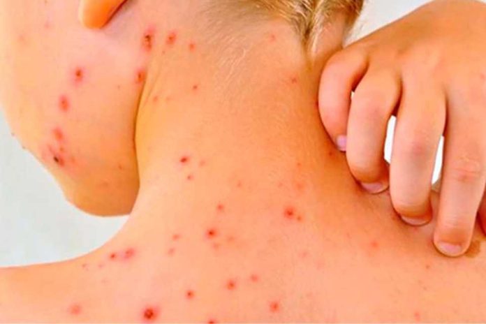 MINSAL informa caso importado de sarampión en Chile