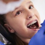 Brackets que se despegan: una de las principales causas de retraso en el tratamiento de ortodoncia con frenillos