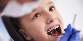 Brackets que se despegan: una de las principales causas de retraso en el tratamiento de ortodoncia con frenillos