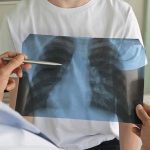 Con la vuelta a la rutina escolar en Chile, las fracturas infantiles son más frecuentes de lo que se cree