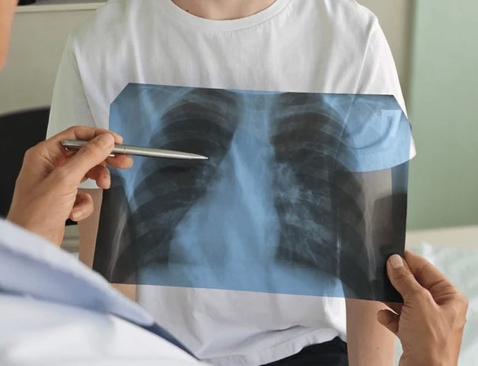 Con la vuelta a la rutina escolar en Chile, las fracturas infantiles son más frecuentes de lo que se cree