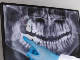 ¿Cuándo sacar las muelas del juicio? Estas son las 5 señales de alerta