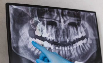 ¿Cuándo sacar las muelas del juicio? Estas son las 5 señales de alerta