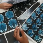 ACV en Chile La segunda causa de muerte y la primera discapacidad adquirida en adultos