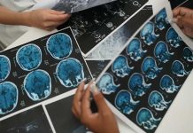 ACV en Chile La segunda causa de muerte y la primera discapacidad adquirida en adultos