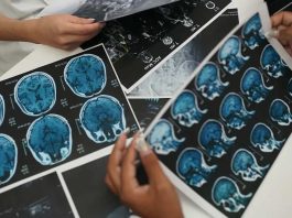 ACV en Chile La segunda causa de muerte y la primera discapacidad adquirida en adultos