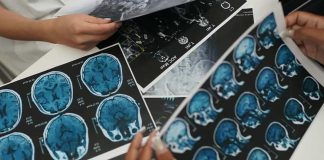 ACV en Chile La segunda causa de muerte y la primera discapacidad adquirida en adultos