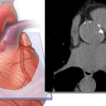 EE.UU |Incluir la medición de grasa cardíaca derivada de IA mejora la precisión en la predicción del riesgo de enfermedad cardiovascular