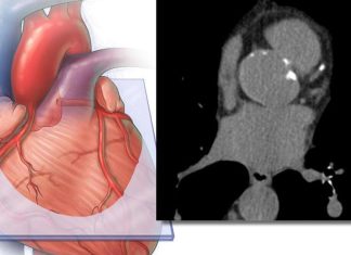EE.UU |Incluir la medición de grasa cardíaca derivada de IA mejora la precisión en la predicción del riesgo de enfermedad cardiovascular