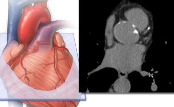 EE.UU |Incluir la medición de grasa cardíaca derivada de IA mejora la precisión en la predicción del riesgo de enfermedad cardiovascular