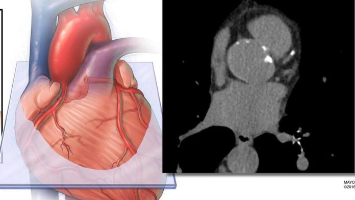 EE.UU |Incluir la medición de grasa cardíaca derivada de IA mejora la precisión en la predicción del riesgo de enfermedad cardiovascular
