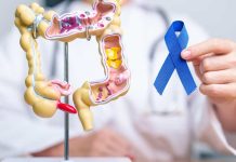 Hasta el 90% del cáncer colorrectal puede curarse con detección temprana