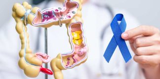 Hasta el 90% del cáncer colorrectal puede curarse con detección temprana Hasta el 90% del cáncer colorrectal puede curarse con detección temprana