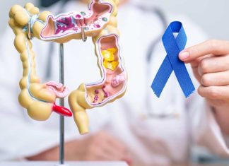 Hasta el 90% del cáncer colorrectal puede curarse con detección temprana
