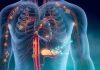 Innovador procedimiento permite tratar coágulos en los pulmones con menor riesgo