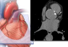 Incluir la medición de grasa cardíaca derivada de IA mejora la precisión en la predicción del riesgo de enfermedad cardiovascular
