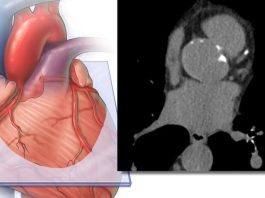 Incluir la medición de grasa cardíaca derivada de IA mejora la precisión en la predicción del riesgo de enfermedad cardiovascular