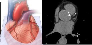 Incluir la medición de grasa cardíaca derivada de IA mejora la precisión en la predicción del riesgo de enfermedad cardiovascular