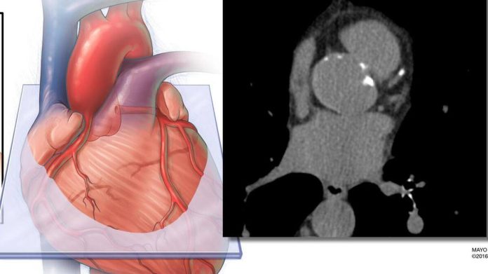 Incluir la medición de grasa cardíaca derivada de IA mejora la precisión en la predicción del riesgo de enfermedad cardiovascular
