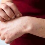 Alerta sanitaria por sarampión: ¿Quiénes deben vacunarse?