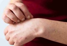 Alerta sanitaria por sarampión: ¿Quiénes deben vacunarse?