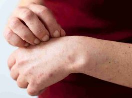 Alerta sanitaria por sarampión: ¿Quiénes deben vacunarse?