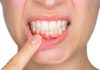 Sangrado de encías no es normal: especialista alerta sobre grave crisis de salud periodontal en Chile Sangrado de encías no es normal: especialista alerta sobre grave crisis de salud periodontal en Chile