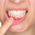 Sangrado de encías no es normal: especialista alerta sobre grave crisis de salud periodontal en Chile Sangrado de encías no es normal: especialista alerta sobre grave crisis de salud periodontal en Chile