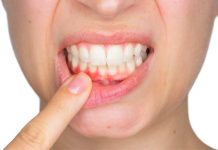 Sangrado de encías no es normal: especialista alerta sobre grave crisis de salud periodontal en Chile Sangrado de encías no es normal: especialista alerta sobre grave crisis de salud periodontal en Chile