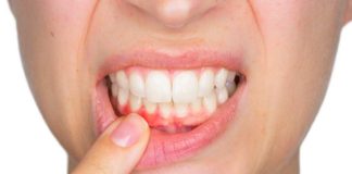 Sangrado de encías no es normal: especialista alerta sobre grave crisis de salud periodontal en Chile Sangrado de encías no es normal: especialista alerta sobre grave crisis de salud periodontal en Chile
