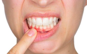 Sangrado de encías no es normal: especialista alerta sobre grave crisis de salud periodontal en Chile