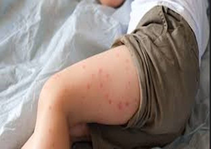 Ante la alerta por sarampión en Perú ¿Qué tan protegido está Chile